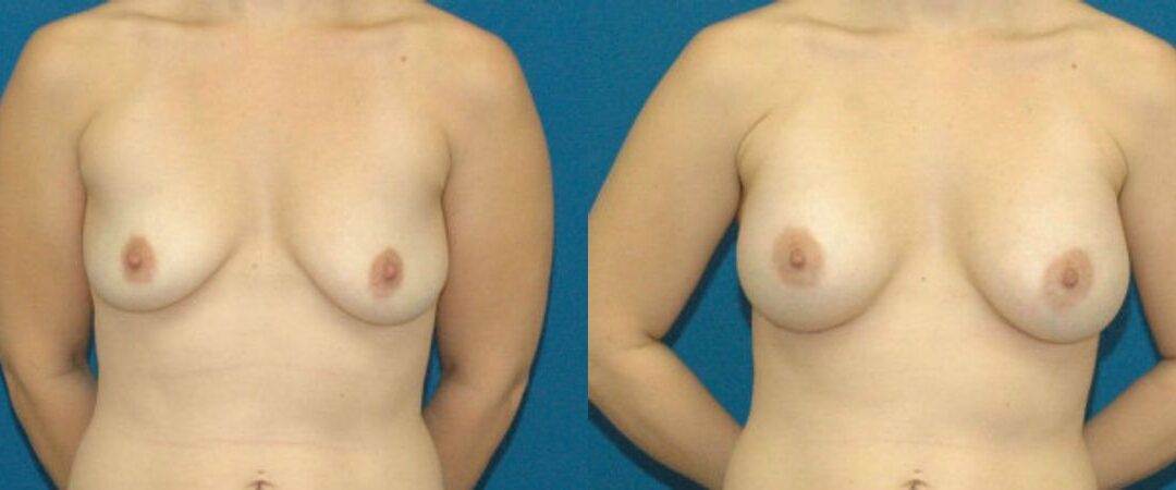 Breast Implant #13
