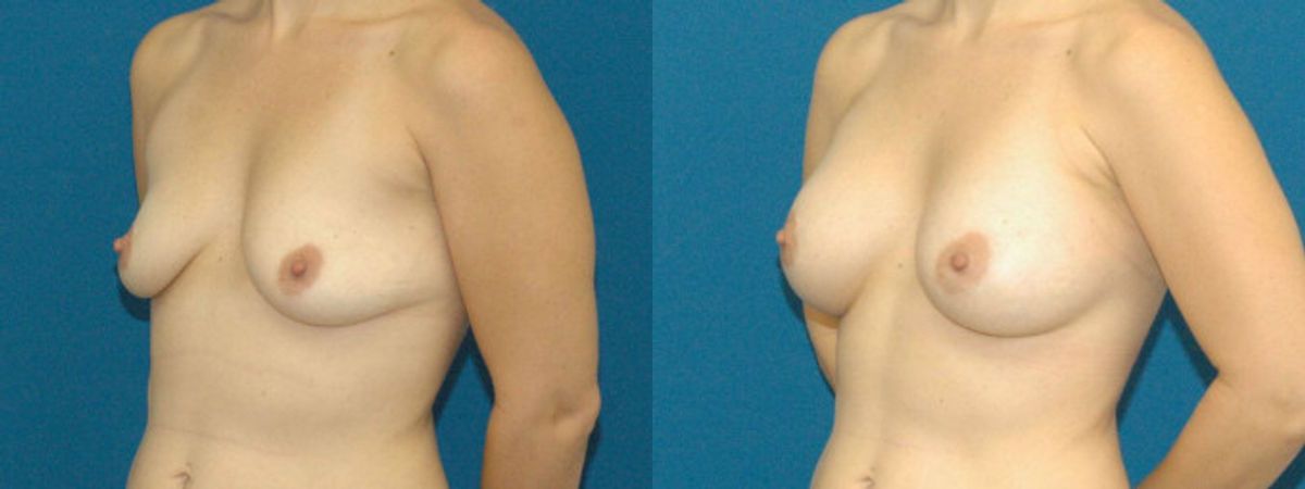 Breast Implant #13 - Before and After