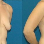 Breast Implant #13 - Before and After