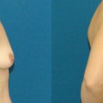 Breast Implant #13 - Before and After