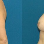 Breast Implant #13 - Before and After