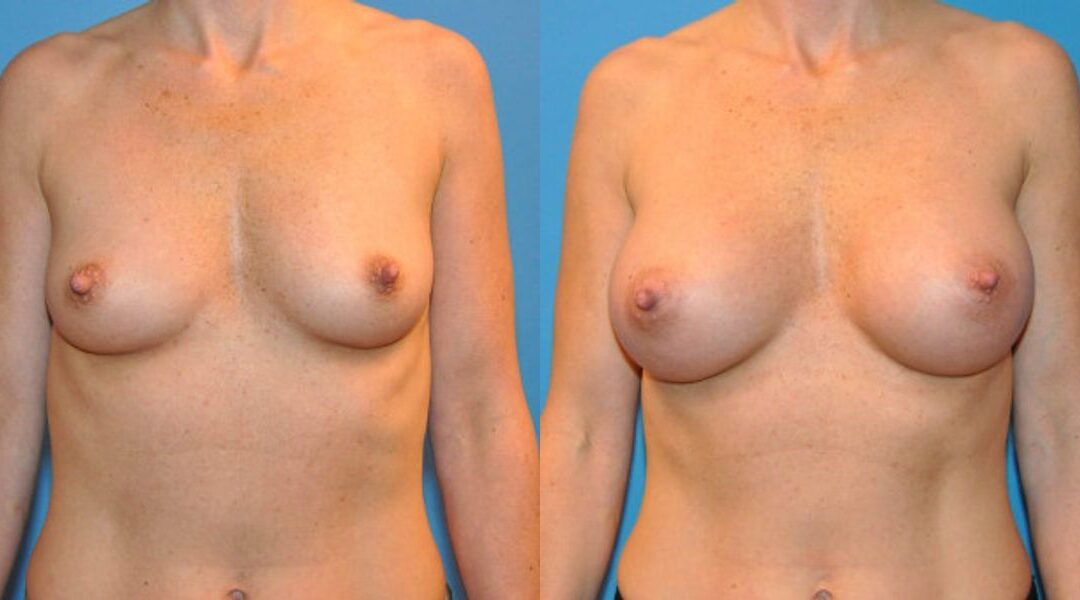 Breast Implant #14