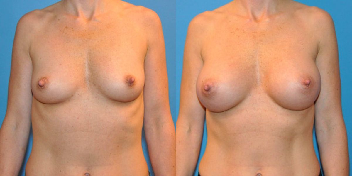 Breast Implant #14 - Before and After