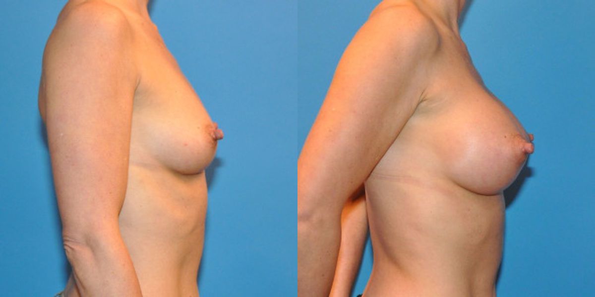 Breast Implant #14 - Before and After