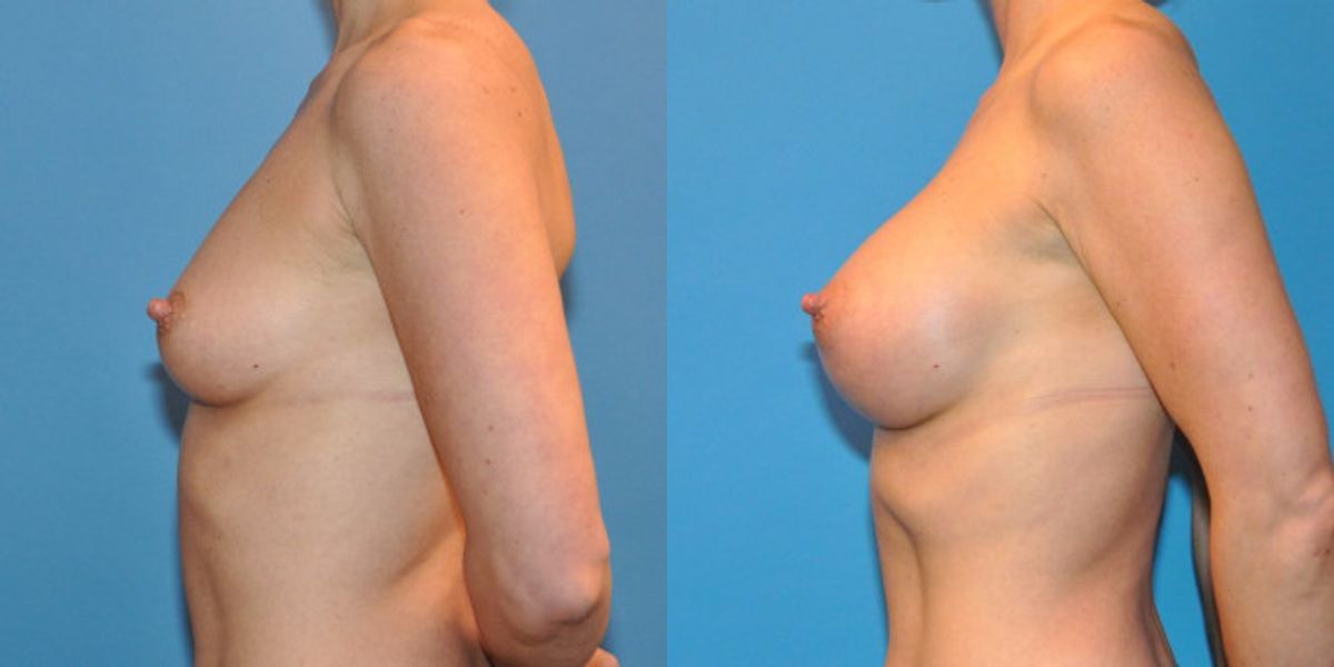 Breast Implant #14 - Before and After