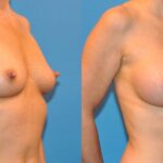 Breast Implant #14 - Before and After
