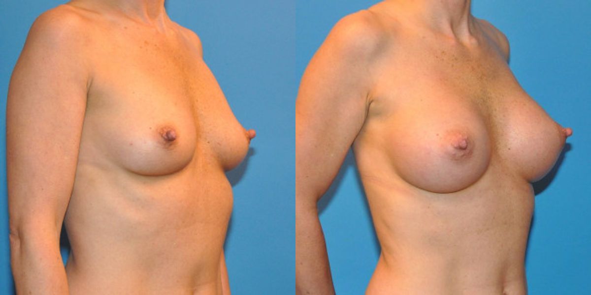 Breast Implant #14 - Before and After