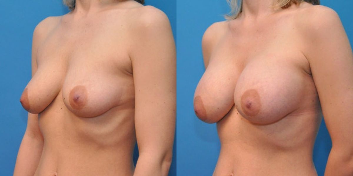 Breast Implant #15 - Before and After