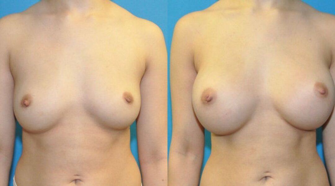 Breast Implant #16