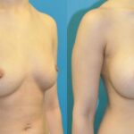 Breast Implant #16 - Before and After