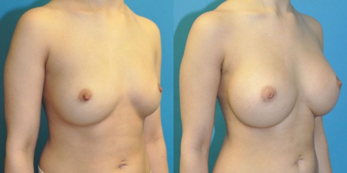 Breast Implant #16 - Before and After