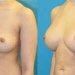 Breast Implant #16 - Before and After