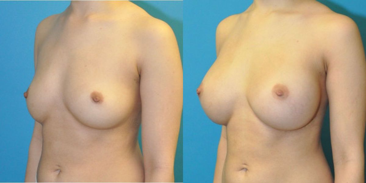Breast Implant #16 - Before and After