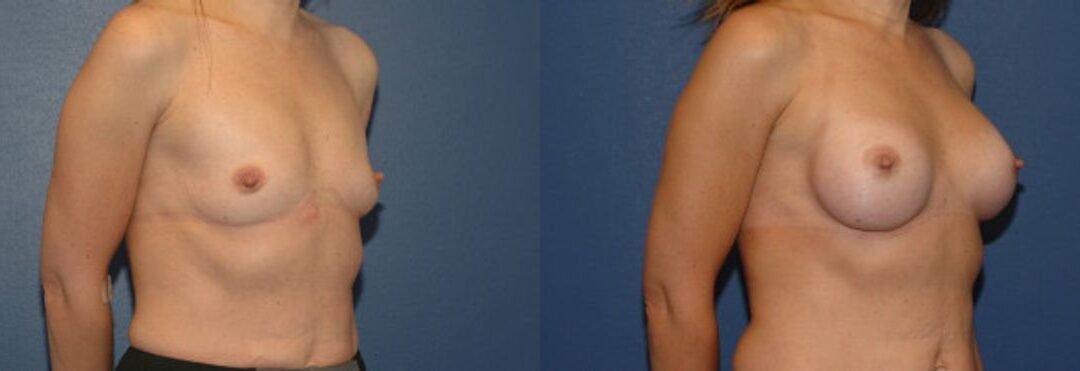 Breast Implant #17