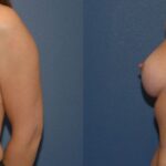 Breast Implant #17 - Before and After