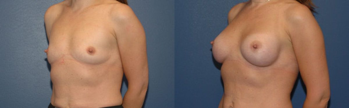 Breast Implant #17 - Before and After