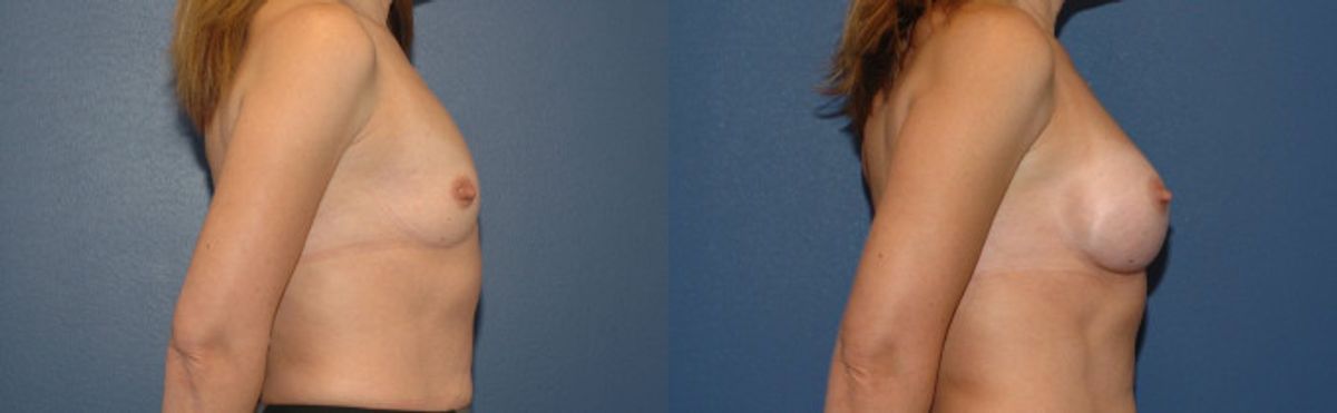 Breast Implant #17 - Before and After
