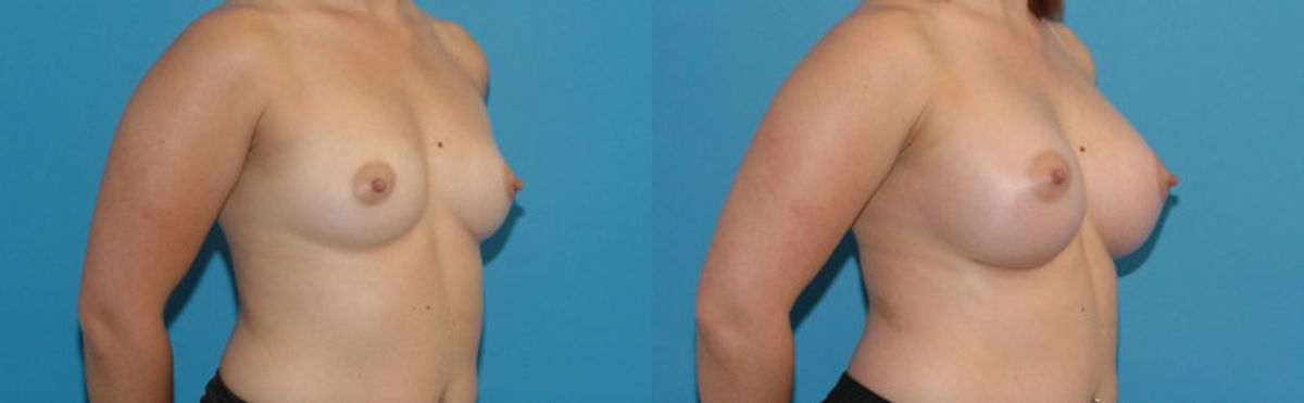 Breast Implant #18 - Before and After
