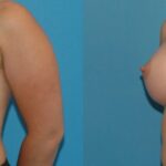 Breast Implant #18 - Before and After