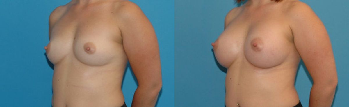 Breast Implant #18 - Before and After