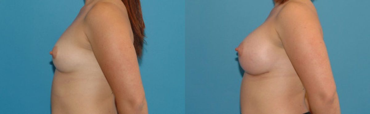 Breast Implant #18 - Before and After