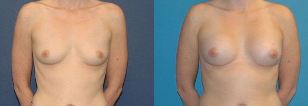 Breast Implant #19