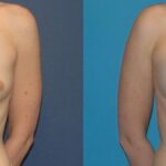Breast Implant #19 - Before and After