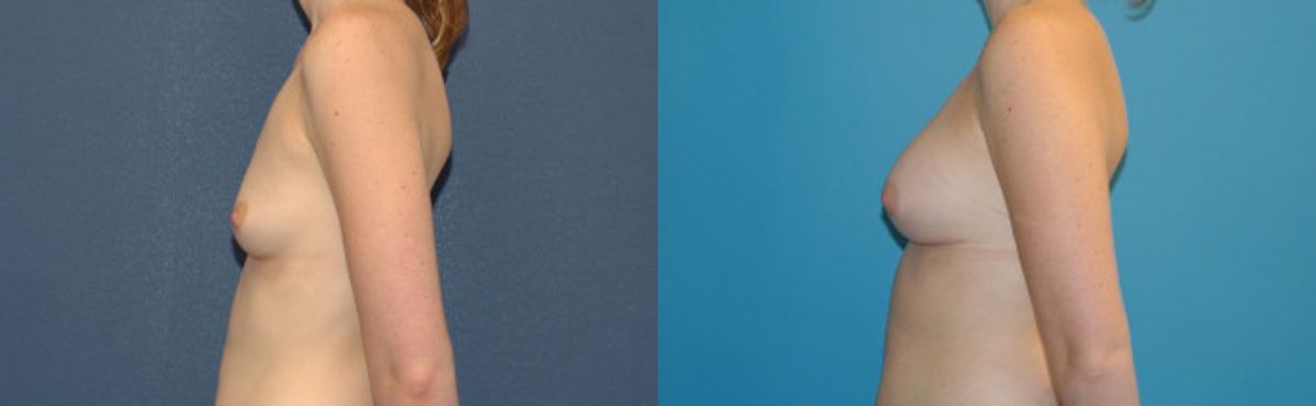 Breast Implant #19 - Before and After