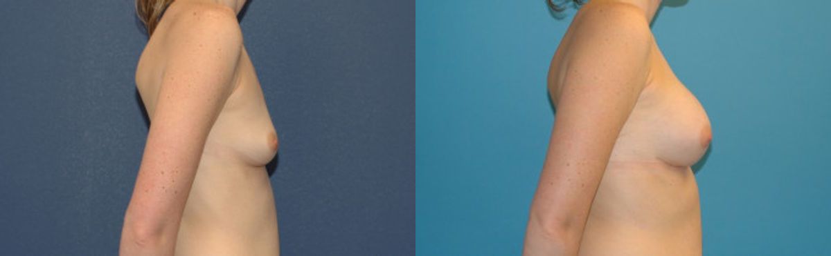 Breast Implant #19 - Before and After