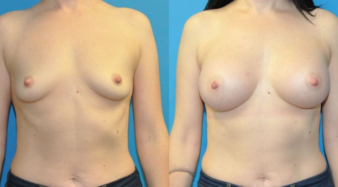 Breast Implant #20
