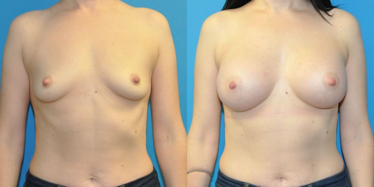 Breast Implant #20 - Before and After