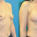 Breast Implant #20 - Before and After