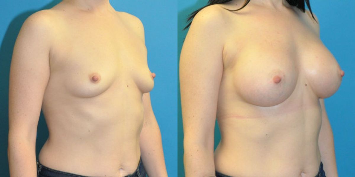 Breast Implant #20 - Before and After