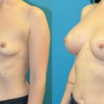 Breast Implant #20 - Before and After