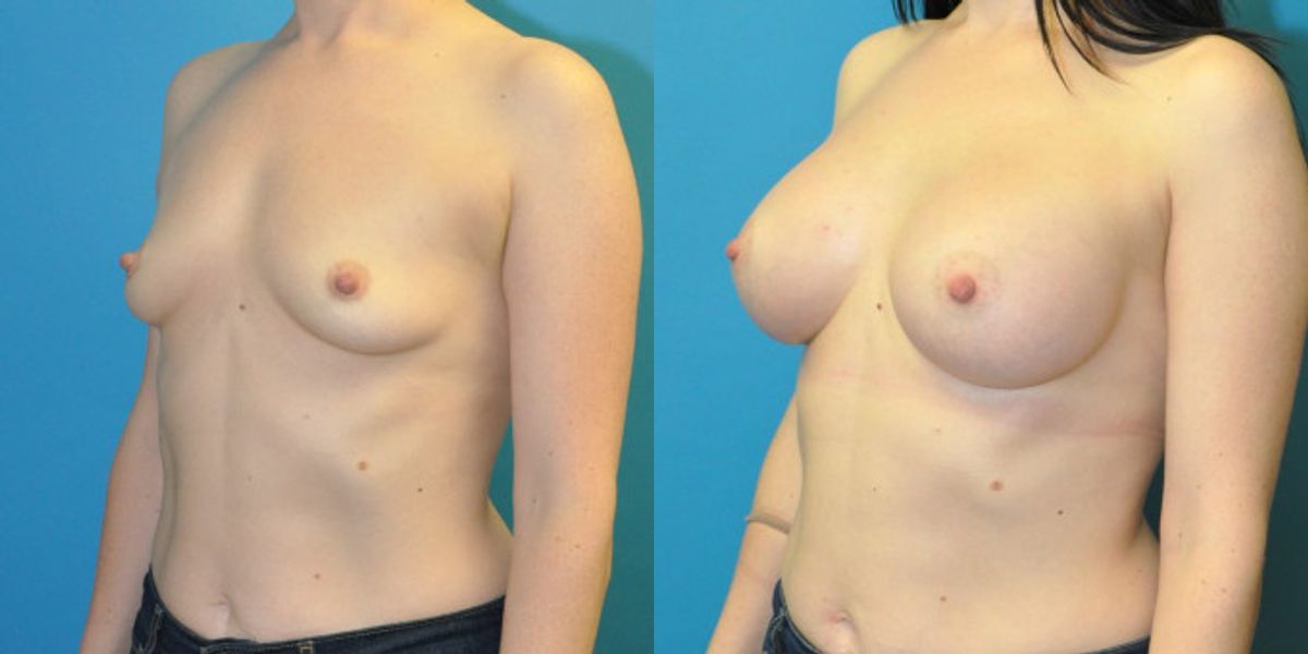 Breast Implant #20 - Before and After