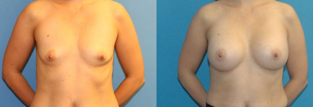 Breast Implant #21