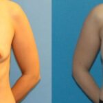 Breast Implant #21 - Before and After