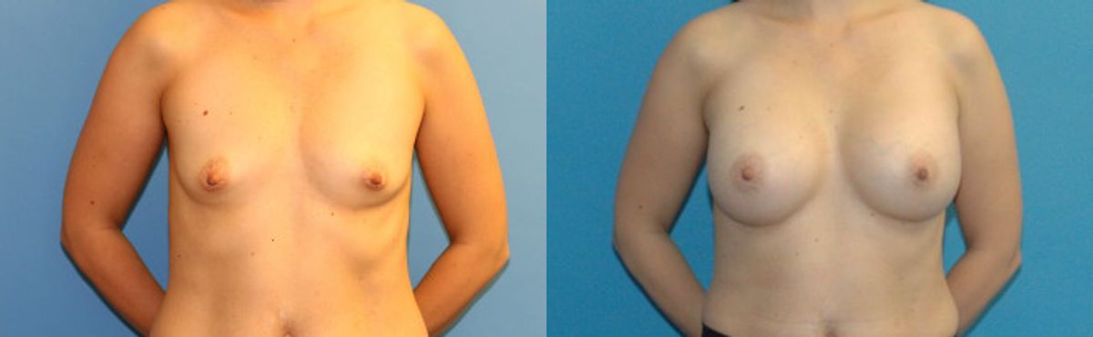 Breast Implant #21 - Before and After