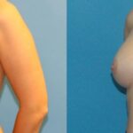 Breast Implant #21 - Before and After