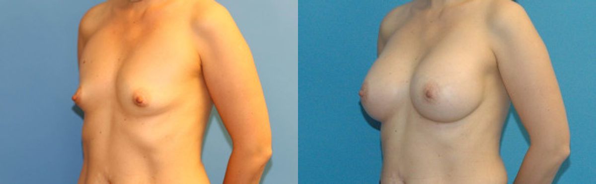 Breast Implant #21 - Before and After