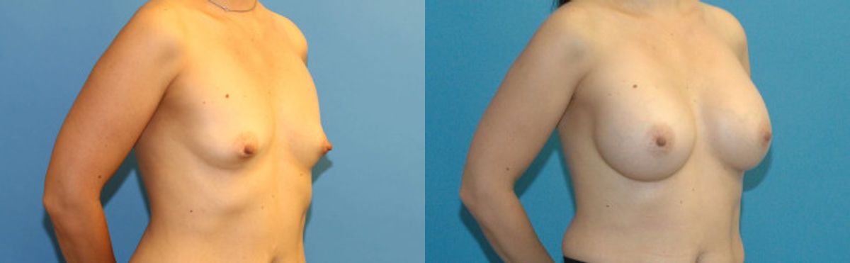 Breast Implant #21 - Before and After