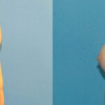 Breast Implant #21 - Before and After