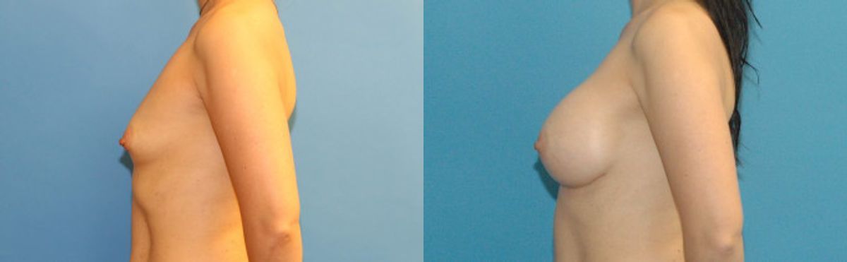 Breast Implant #21 - Before and After