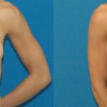 Breast Implant #22 - Before and After