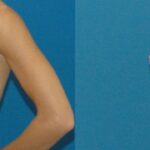 Breast Implant #22 - Before and After