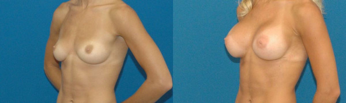 Breast Implant #22 - Before and After
