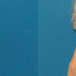 Breast Implant #22 - Before and After