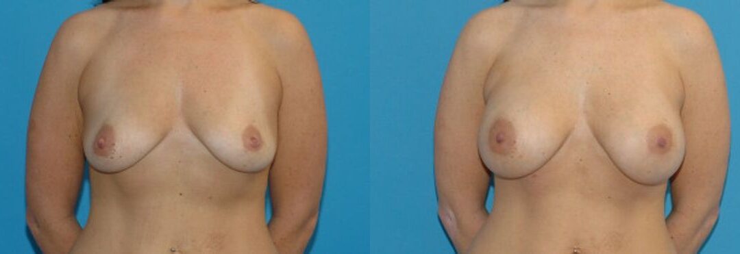 Breast Implant #23