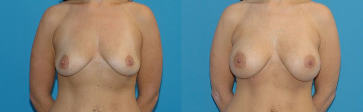 Breast Implant #23 - Before and After