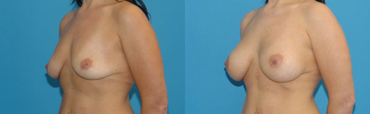 Breast Implant #23 - Before and After
